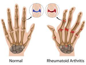 artrite reumatoide