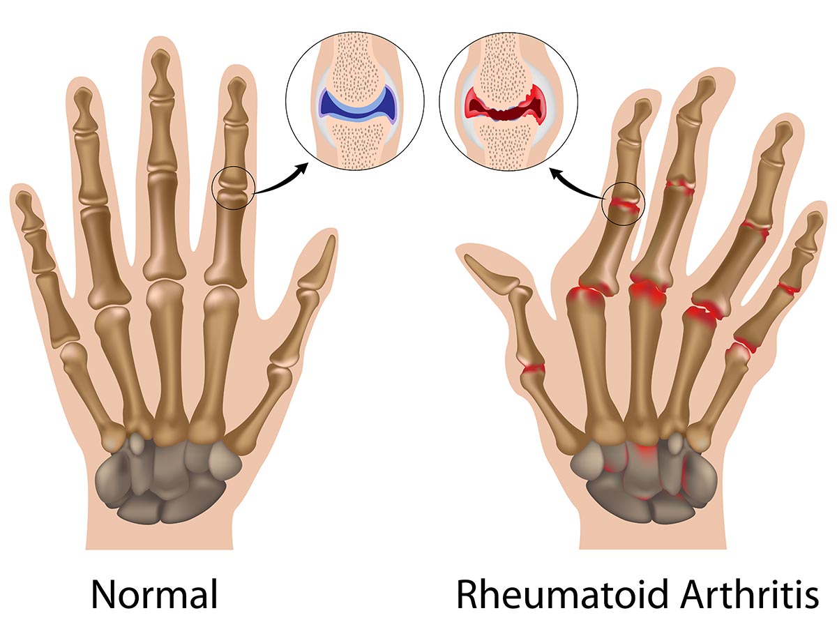 artrite reumatoide